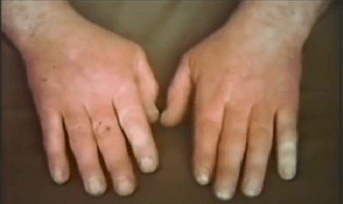 Hand Arm Vibration symptoms to hands